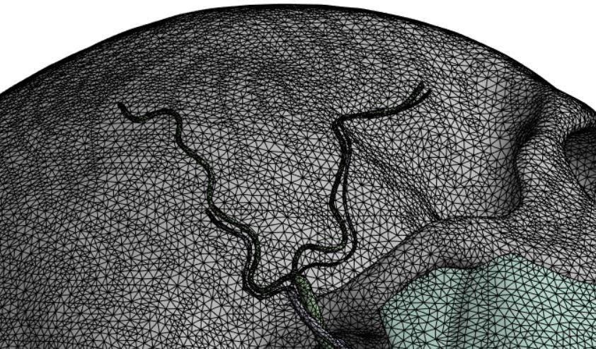 Anatomical FEM model — Mesh detail, contact zones