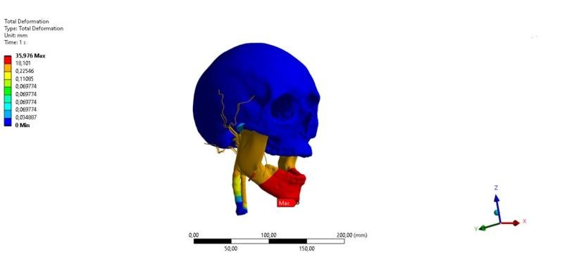 Jaw displacement study — Displacement map, millimetres
